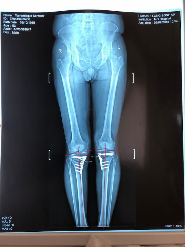 Хөлийн тэнхлэг засах мэс засал image10