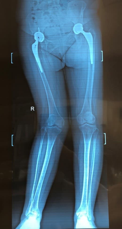 Хөлийн тэнхлэг засах мэс засал image11