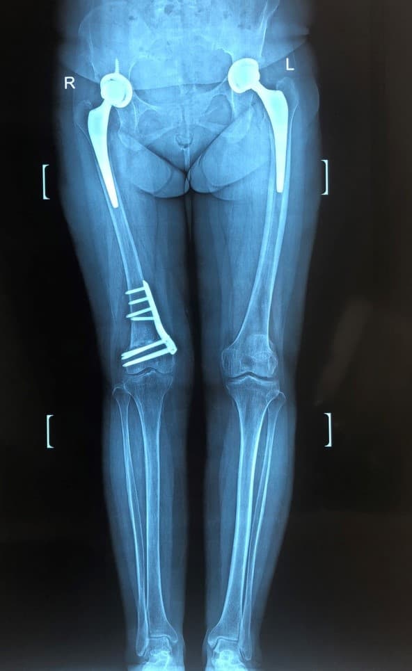 Хөлийн тэнхлэг засах мэс засал image12