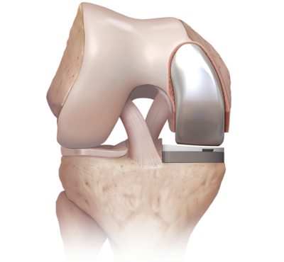 Өвдөгний үе хагас солих мэс засал (UKA) image2