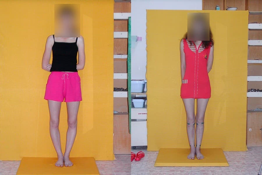 Хөлийн тэнхлэг засах мэс засал image4