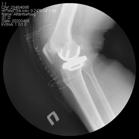 Өвдөгний үе хагас солих мэс засал (UKA) image5