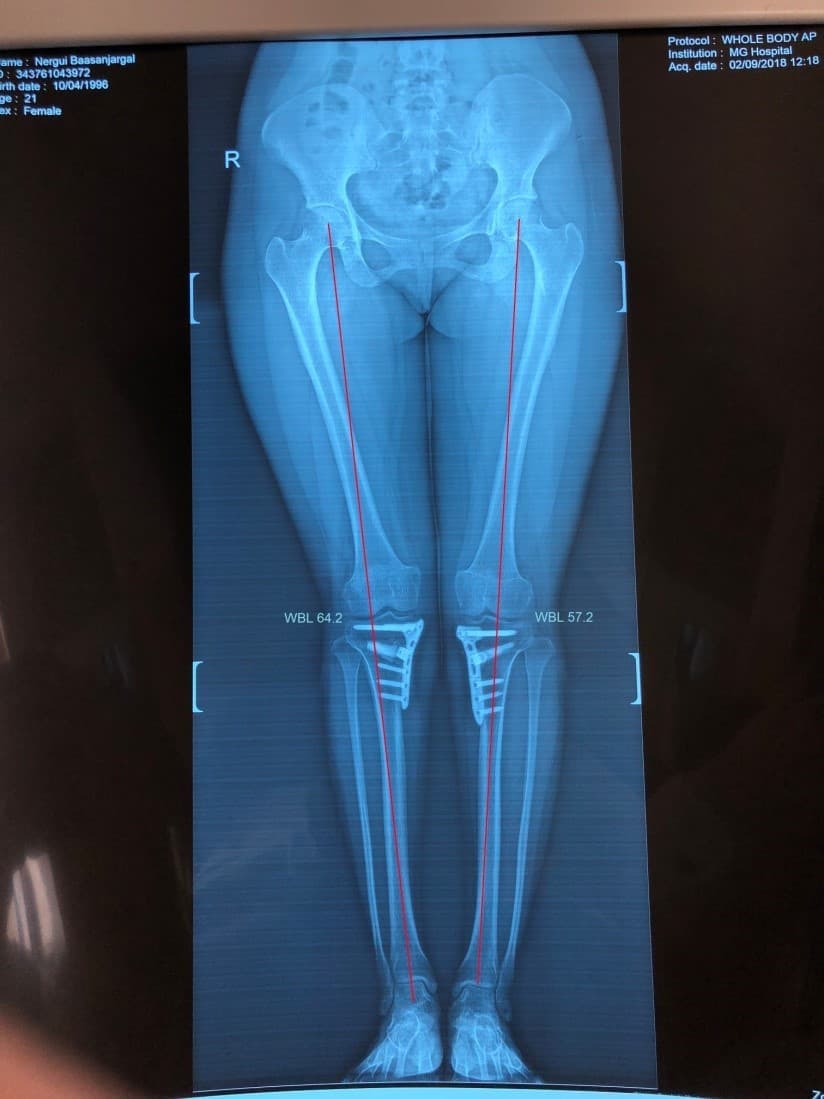 Хөлийн тэнхлэг засах мэс засал image6