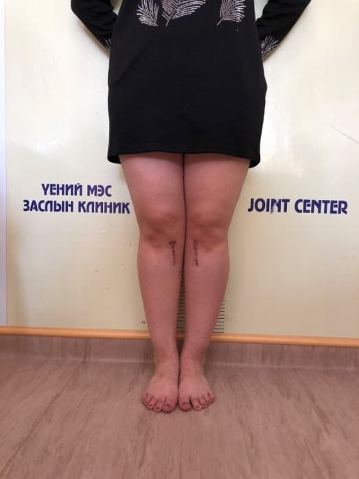 Хөлийн тэнхлэг засах мэс засал image8