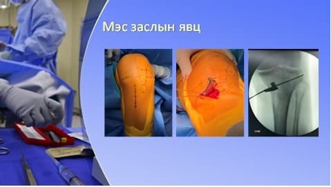 Хөлийн тэнхлэг засах мэс засал image