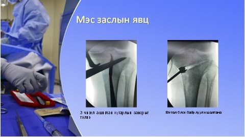 Хөлийн тэнхлэг засах мэс засал image1