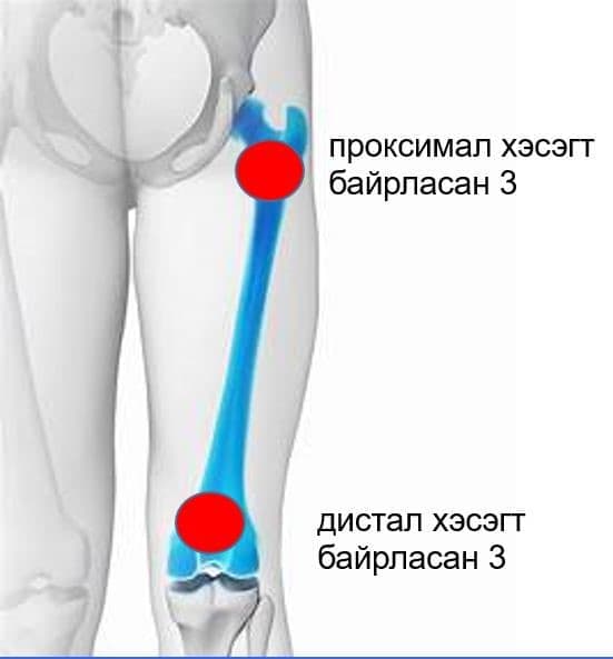 Үе дайрсан ясны анхдагч хавдар, ясны дутмагшлын үед хийгдэх мэс засал image1