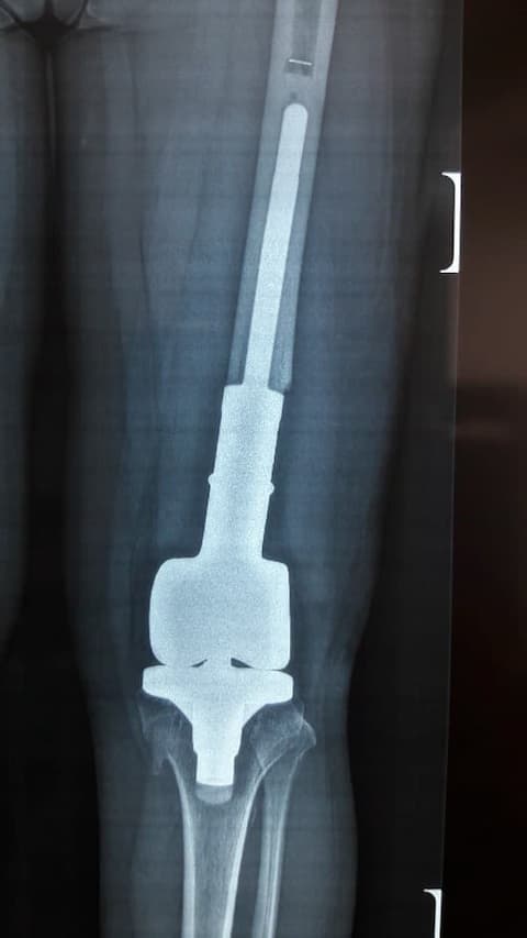 Үе дайрсан ясны анхдагч хавдар, ясны дутмагшлын үед хийгдэх мэс засалimage10