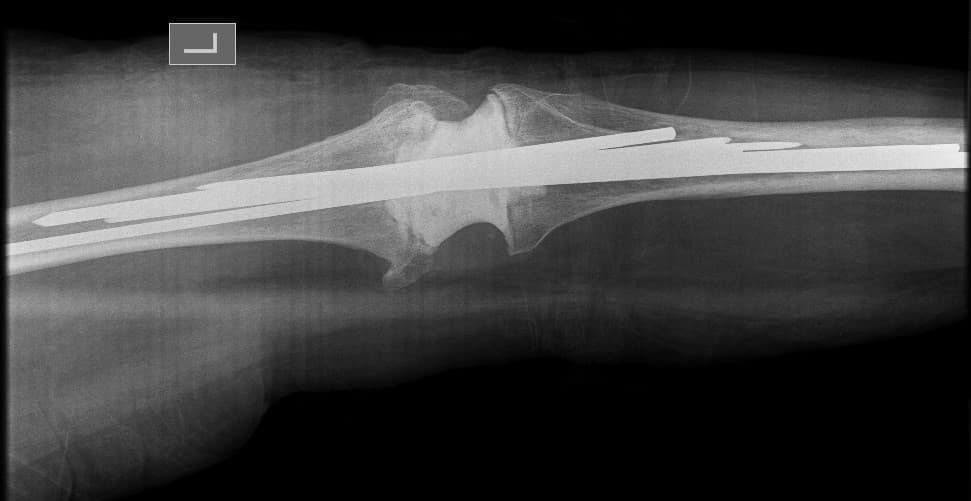 Үе дайрсан ясны анхдагч хавдар, ясны дутмагшлын үед хийгдэх мэс засалimage13