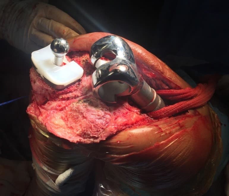 Үе дайрсан ясны анхдагч хавдар, ясны дутмагшлын үед хийгдэх мэс засалimage14