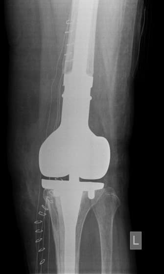 Үе дайрсан ясны анхдагч хавдар, ясны дутмагшлын үед хийгдэх мэс засалimg15