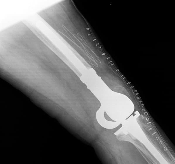 Үе дайрсан ясны анхдагч хавдар, ясны дутмагшлын үед хийгдэх мэс засалimg16