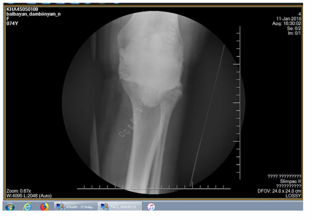 Үе дайрсан ясны анхдагч хавдар, ясны дутмагшлын үед хийгдэх мэс засалimg17