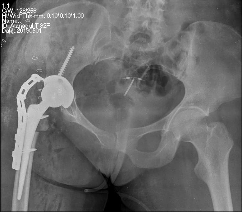 Түнхний үе солих мэс засал гэж юу вэ image17