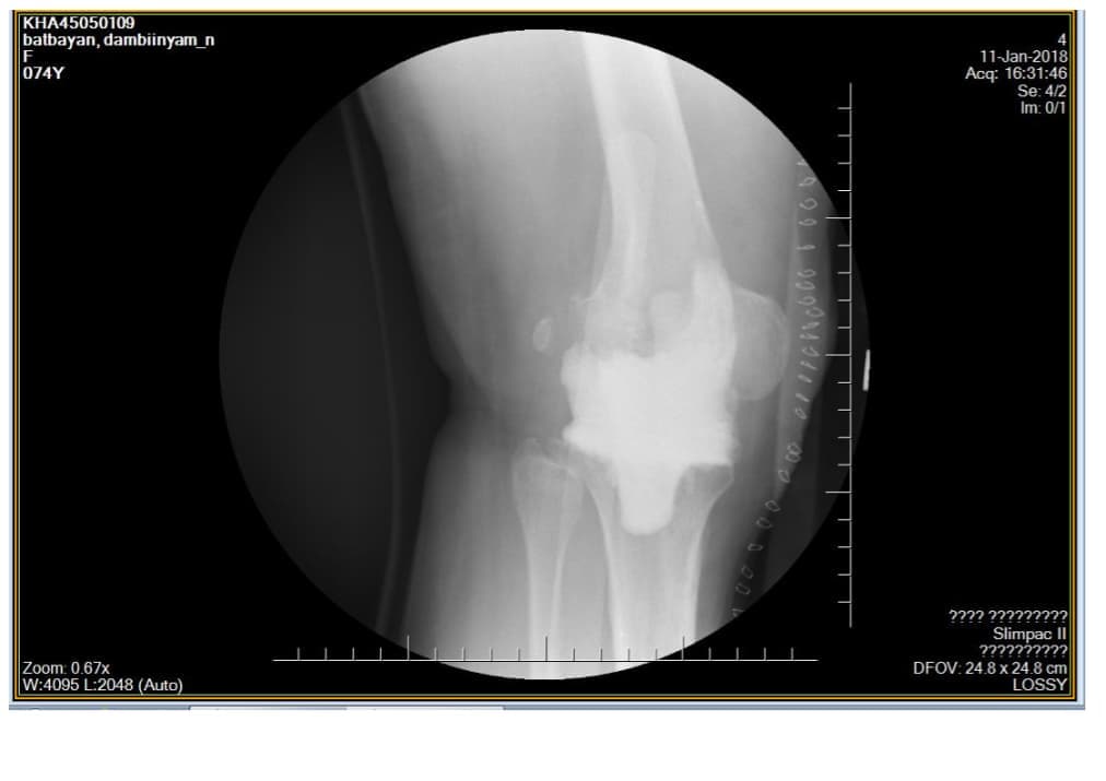 Үе дайрсан ясны анхдагч хавдар, ясны дутмагшлын үед хийгдэх мэс засалimg18
