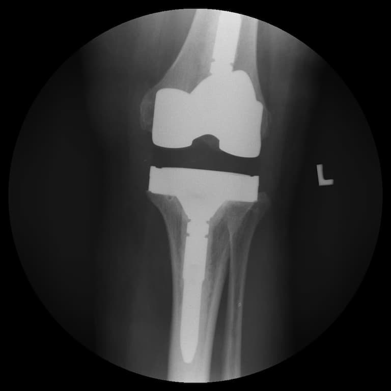 Үе дайрсан ясны анхдагч хавдар, ясны дутмагшлын үед хийгдэх мэс засалimg20