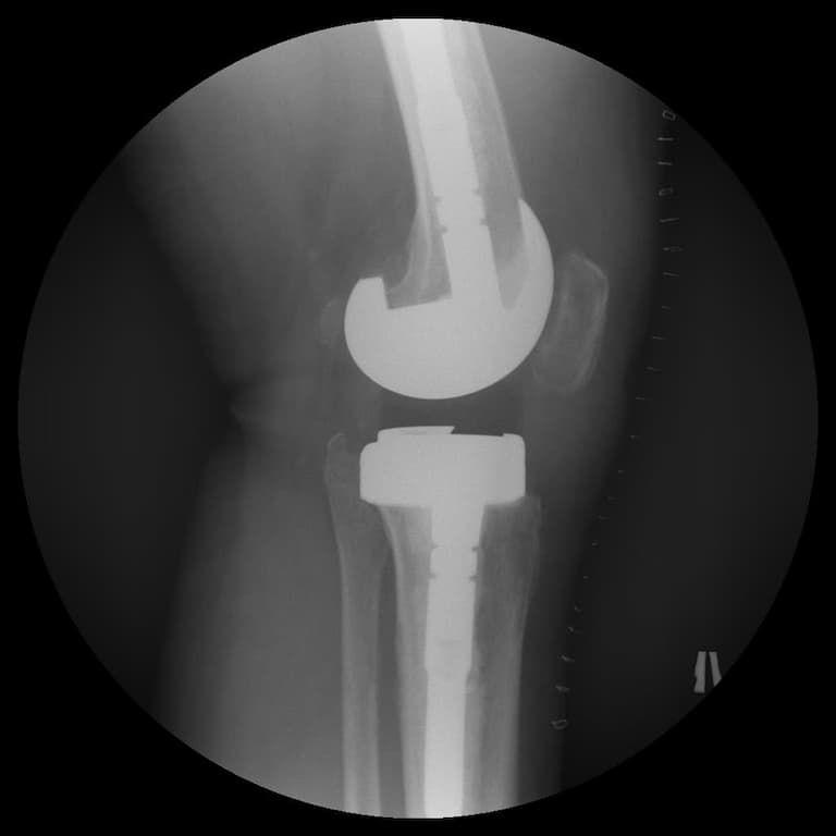 Үе дайрсан ясны анхдагч хавдар, ясны дутмагшлын үед хийгдэх мэс засалimg21