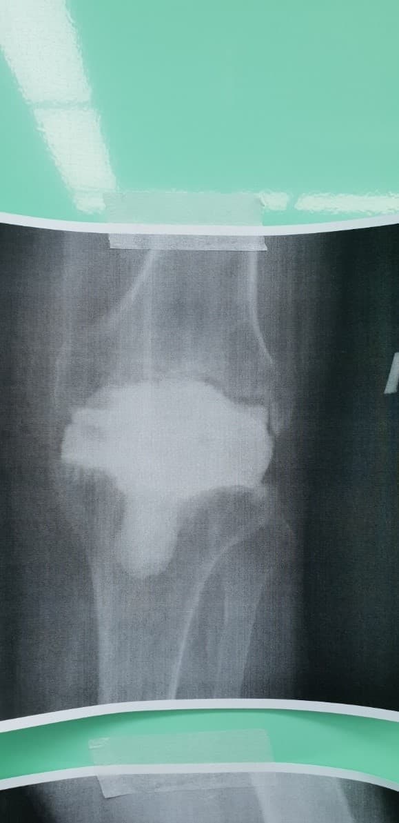 Үе дайрсан ясны анхдагч хавдар, ясны дутмагшлын үед хийгдэх мэс засалimg22