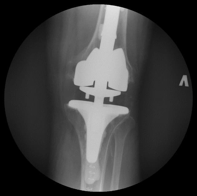 Үе дайрсан ясны анхдагч хавдар, ясны дутмагшлын үед хийгдэх мэс засалimg24