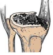 Үе дайрсан ясны анхдагч хавдар, ясны дутмагшлын үед хийгдэх мэс засалimage26