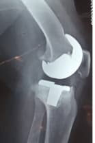 Үе дайрсан ясны анхдагч хавдар, ясны дутмагшлын үед хийгдэх мэс засалimg28