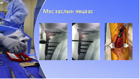 Хөлийн тэнхлэг засах мэс засал image3