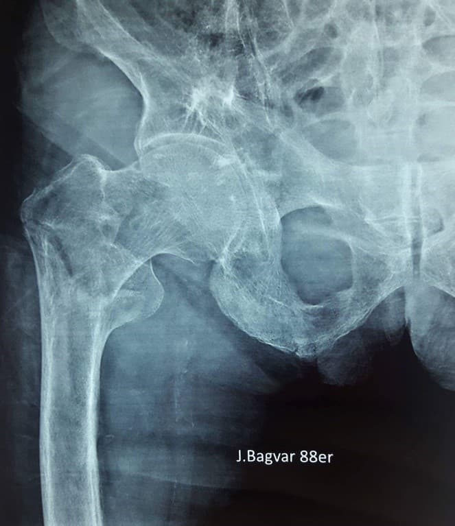 Түнхний үе хагас солих мэс засал (Bipolar Hip QRL)image3