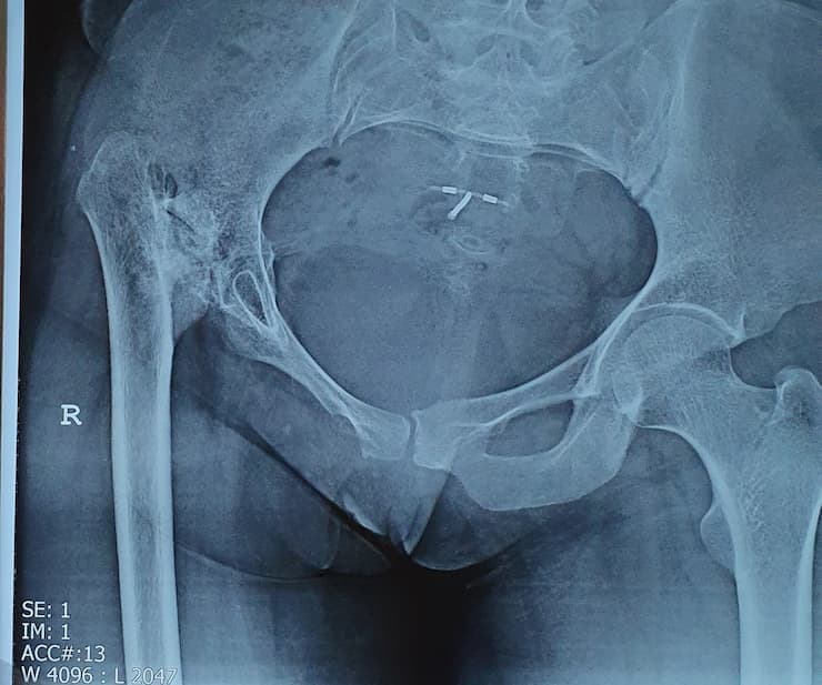 Түнхний үе бүтэн солих мэс засал (THA) image3