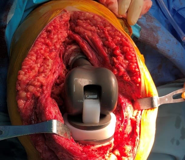 Үе дайрсан ясны анхдагч хавдар, ясны дутмагшлын үед хийгдэх мэс засалimage33