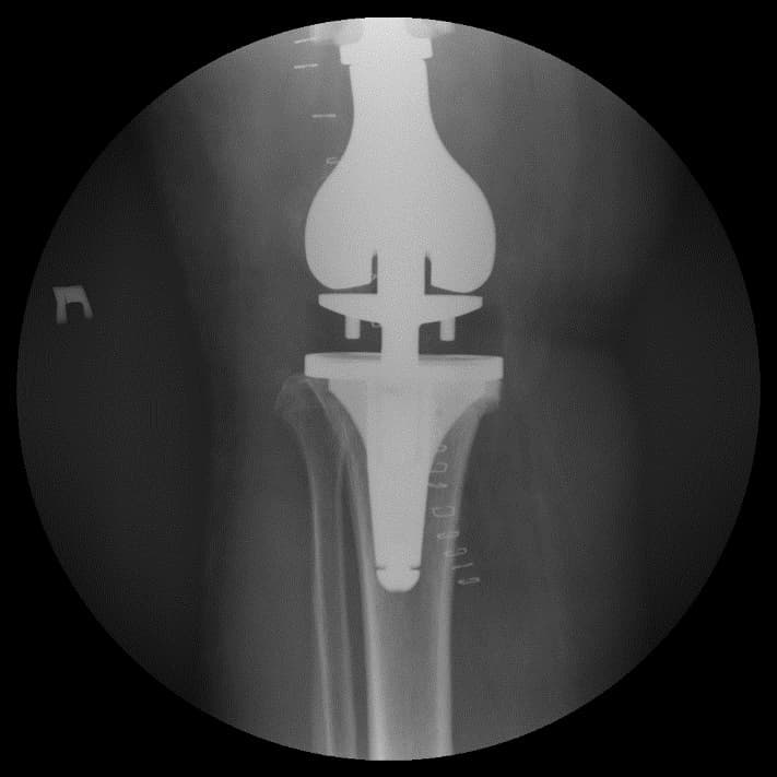 Үе дайрсан ясны анхдагч хавдар, ясны дутмагшлын үед хийгдэх мэс засалimg34