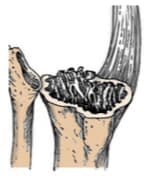 Үе дайрсан ясны анхдагч хавдар, ясны дутмагшлын үед хийгдэх мэс засалimage36