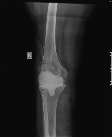 Үе дайрсан ясны анхдагч хавдар, ясны дутмагшлын үед хийгдэх мэс засалimg37