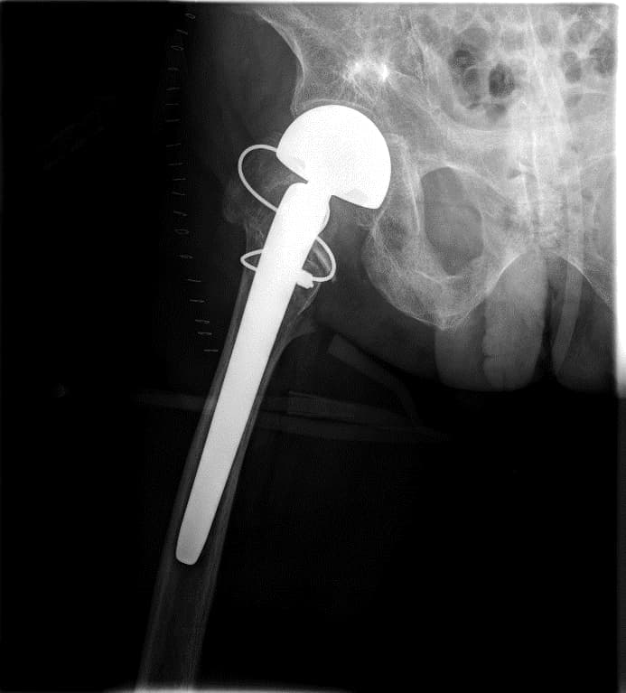 Түнхний үе хагас солих мэс засал (Bipolar Hip QRL)image4