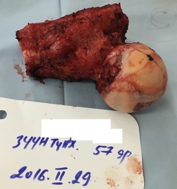 Үе дайрсан ясны анхдагч хавдар, ясны дутмагшлын үед хийгдэх мэс засалimage4