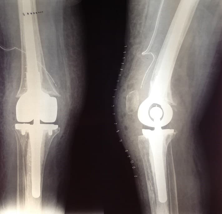 Үе дайрсан ясны анхдагч хавдар, ясны дутмагшлын үед хийгдэх мэс засалimage40