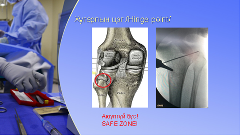 Хөлийн тэнхлэг засах мэс засал image5