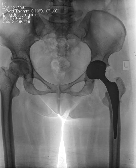 Түнхний үе солих мэс засал гэж юу вэ image6