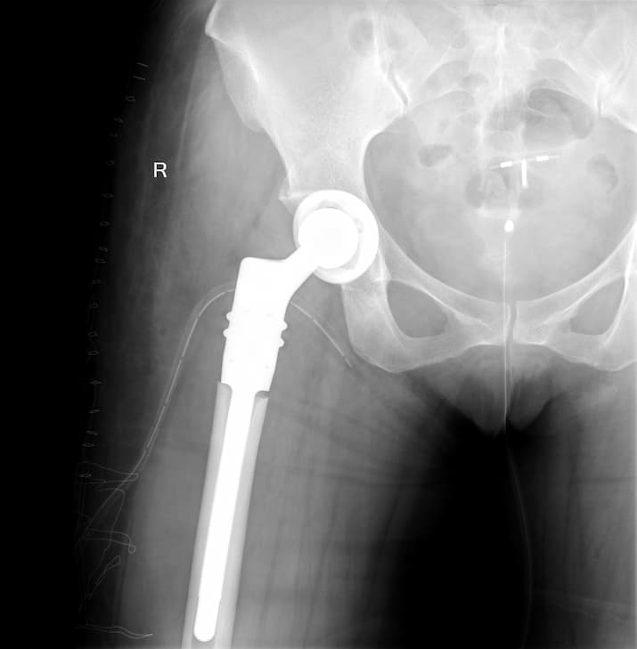 Түнхний үе бүтэн солих мэс засал (THA) image7