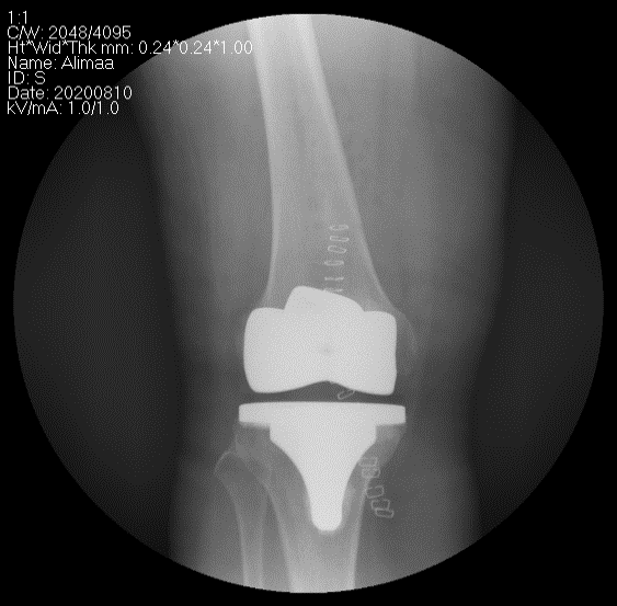 Өвдөгний үе бүтэн солих мэс засал (TKA) image9