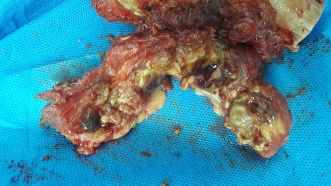 Үе дайрсан ясны анхдагч хавдар, ясны дутмагшлын үед хийгдэх мэс засалimage9